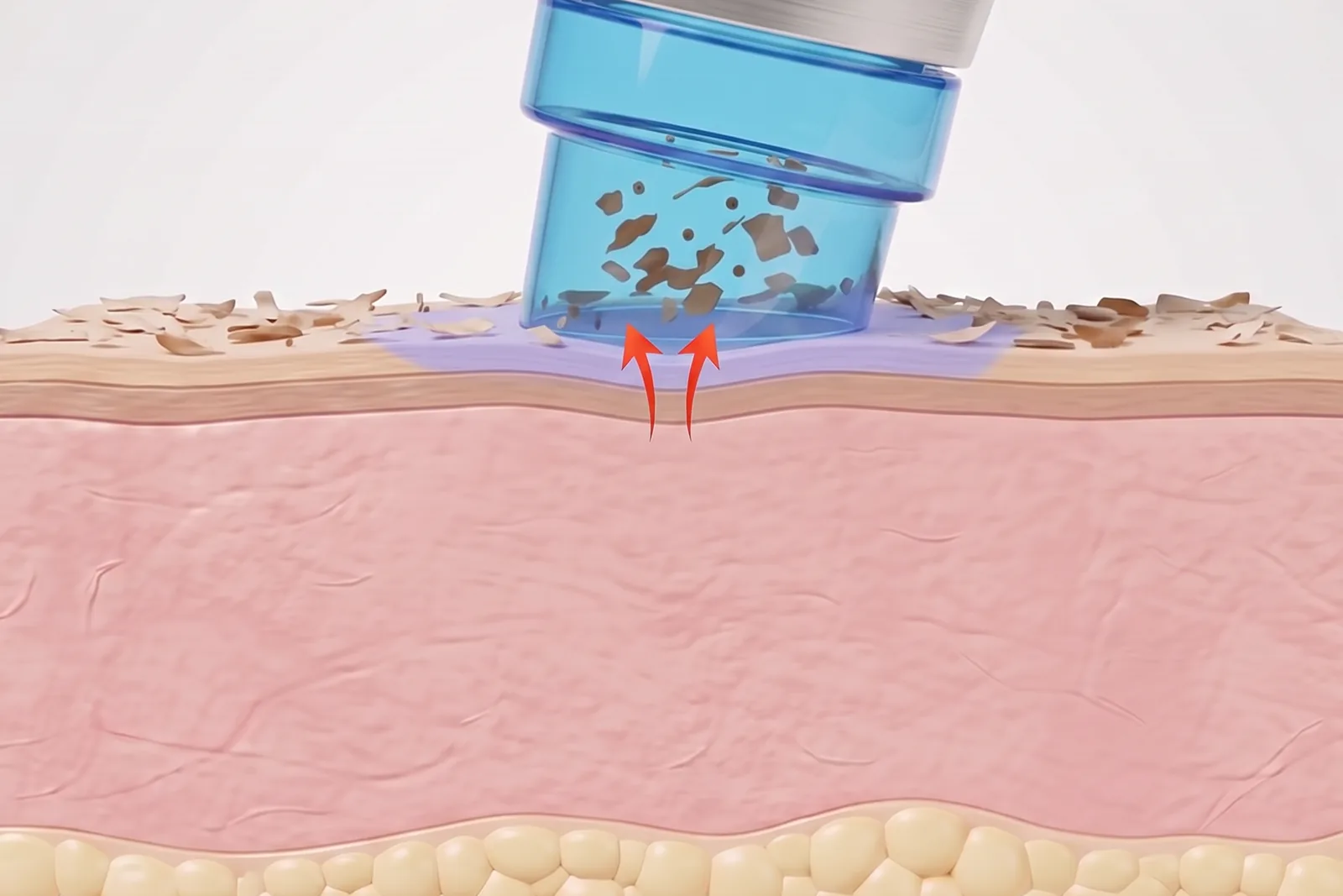 Illustration: Hydra-Aufsatz auf der Haut beim Peeling mit S2