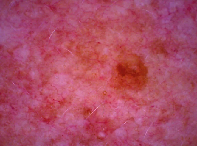 Pigmentierung: Aufnahme der Mikrokamera